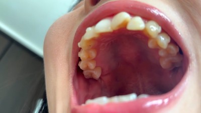 街角で声をかけて口内観察させてもらう ファーストフード店パート みおりさん